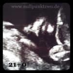 Der 2. große Ultraschall | Kind 3