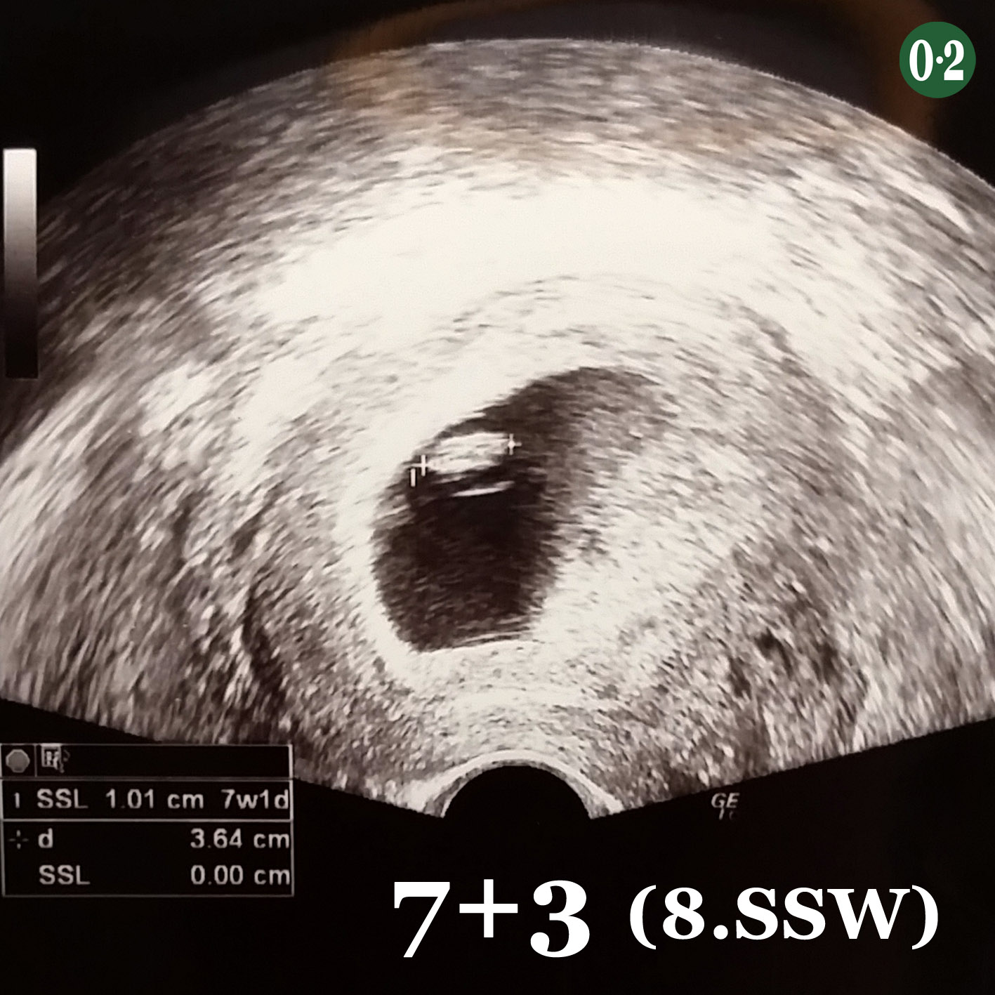 Ultraschall Ssw8 Nullpunktzwo