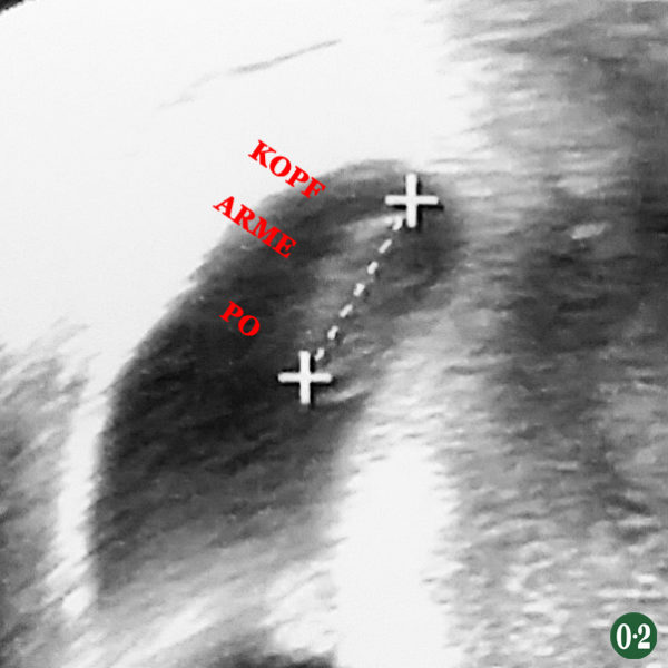 Ultraschall 07+5 mit Embryo