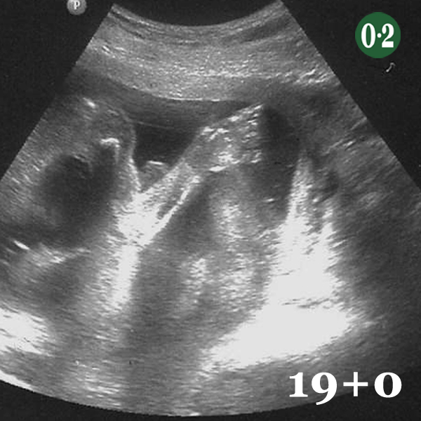 Ultraschall bei 19+0 - Babyturnen