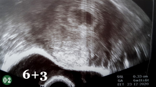 Ultraschall 06+3 mit Fruchthöhle, Dottersack, 3mm Embryo und fraglicher Herzaktivität